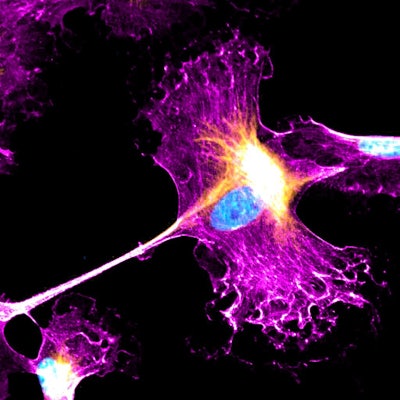 Image showing one cellular response to Leptomycin B, with F-actin (pink), vimentin (yellow), and DAPI (cyan), in canine epithelial cells (MDCK I) cultured on soft hydrogels. This study demonstrates diverse epithelial-mesenchymal responses to nuclear export inhibition, including concurrent elevation of epithelial and mesenchymal cellular traits. The image was acquired on a laser-scanning confocal microscope using a 40X objective. (Credit: Carly Krull, Department of Biomedical Engineering)