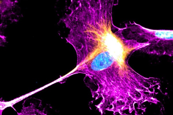 Image showing one cellular response to Leptomycin B, with F-actin (pink), vimentin (yellow), and DAPI (cyan), in canine epithelial cells (MDCK I) cultured on soft hydrogels. This study demonstrates diverse epithelial-mesenchymal responses to nuclear export inhibition, including concurrent elevation of epithelial and mesenchymal cellular traits. The image was acquired on a laser-scanning confocal microscope using a 40X objective. (Credit: Carly Krull, Department of Biomedical Engineering)