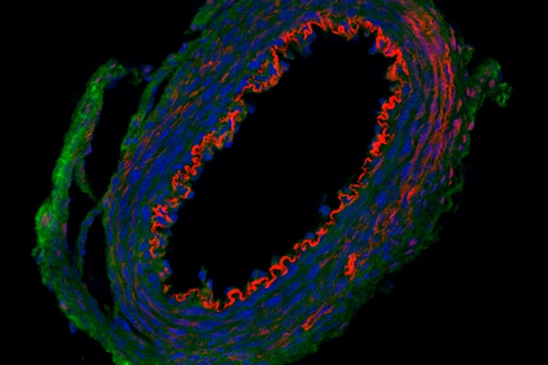 In supravalvular aortic stenosis, a defect in the deposition of elastin during development causes the aorta to narrow, restricting blood flow.. (Credit: Wagenseil lab)