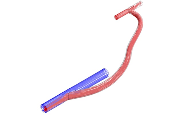 Rendering of an arteriovenous graft. The blue section represents a vein, the short red section an artery and the longer red section, a graft connecting the two. (Image courtesy Mohamed Zayed, MD)