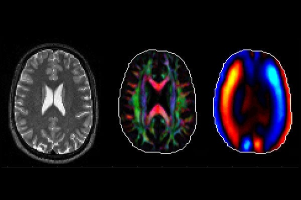 Philip Bayly and a team of collaborators will study the mechanical causes behind traumatic brain injury using models and images such as these, which show (from left) a brain MRI, brain fiber tracts and shear waves in the brain. (Courtesy: Bayly lab)