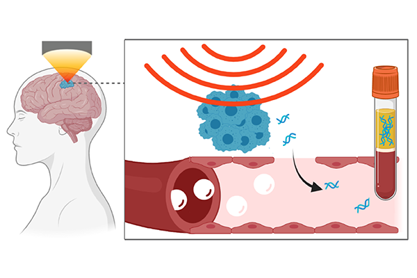 Hong Chen and her collaborators found that using focused-ultrasound-mediated liquid biopsy in a mouse model released more tau proteins and another biomarker for neurodegenerative disorders into the blood than without the intervention. This noninvasive method could facilitate diagnosis of neurodegenerative disorders. (Chen lab)