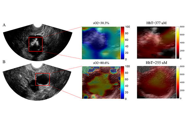 (From left) The top row shows an ultrasound image of a malignant lesion, the blood oxygen saturation, and hemoglobin concentration. The bottom row is an ultrasound image of a benign lesion, the blood oxygen saturation, and hemoglobin concentration. (Credit: Zhu lab)