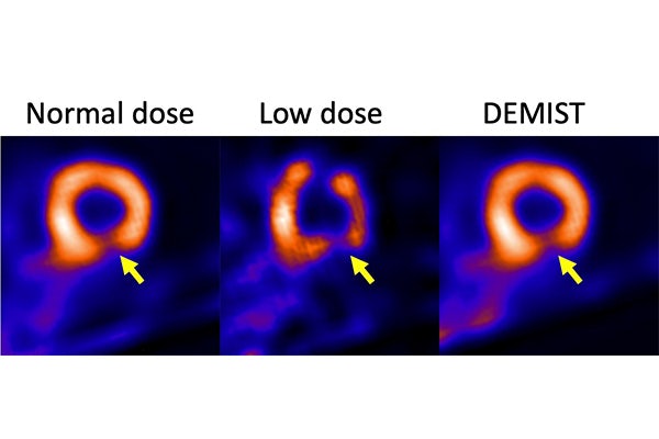 Low-dose (second from left) SPECT images that have been denoised using the proposed DEMIST method (right). Normal-dose images are on the left for reference. The image is less noisy and the defect became more detectable and visually clearer with DEMIST. (Credit: Abhinav Jha)