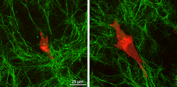Image showing single cancer cells (MDA-MB-231, red) on top of collagen (green) layers with soft (left) or stiff (right) underlying polyacrylamide hydrogels. This study reveals a feedback mechanism in cancer cells, but not normal cells, that allows them to sense stiffness deep into layered extracellular matrices. Scale bar, 25 μm. (Credit: Christopher Walter, Department of Mechanical Engineering & Materials Science)