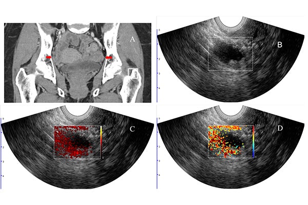 Quing Zhu, working with Matthew Powell, MD, and Cary Siegel, MD, from the School of Medicine, developed a new imaging method to better diagnose lesions in the ovaries and adjacent adnexa that may help to avoid unnecessary surgeries. This image shows a woman with pelvic mass and BRCA1 mutation. The arrows point to the right and left adnexa. Co-registered ultrasound shows a cyst with solid component in the right adnexa (B). Image C shows the relative total hemoglobin in the lesion, and image D shows the oxygen saturation, both of which are important predictors of malignancy. Pathology revealed a stage I high-grade serous carcinoma of the right ovary and fallopian tube. (Credit: Zhu lab