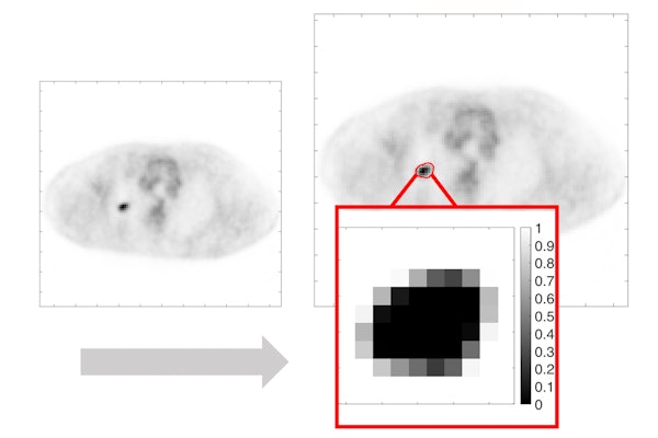 The image on the left is a PET image with tumor that is input into the Jha lab's tissue-fraction estimation approach. The image on the right is the output, with the tumor-fraction areas enhanced.