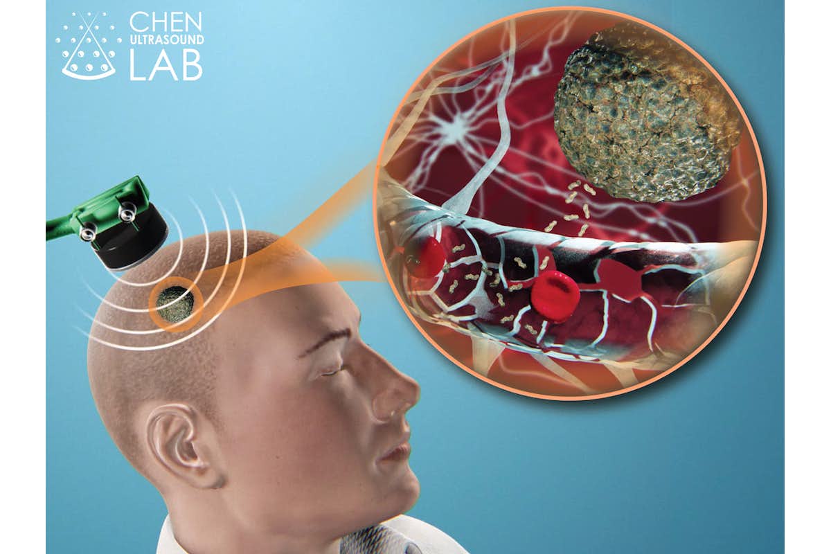 A team of researchers led by Hong Chen and Eric Leuthardt, MD, at Washington University in St. Louis has developed a noninvasive diagnostic method that may one day replace the biopsy with a simple blood test.