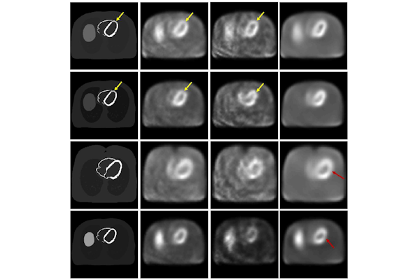 In these representative reconstructed images, the column on the left represents ground truth and the column on the right shows a scanned image after AI denoising. In these examples, AI-based denoising methods reduced clinical usefulness by removing defects (top two rows, defects marked by yellow arrows) or introducing false defects (bottom two rows, defects marked by red arrows). (Image courtesy of Jha lab)