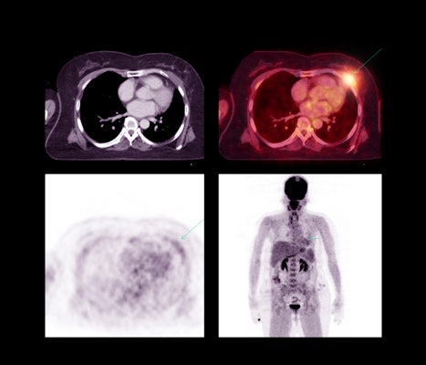 Positron emission tomography (PET) scans are often used to detect lung and other cancers. A new study led by Abhinav Jha underscores the need for an objective, task-based evaluation of PET segmentation algorithms, which have become powerful tools supporting patient care and medical diagnostics. (Image: iStock)