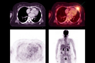 Positron emission tomography (PET) scans are often used to detect lung and other cancers. A new study led by Abhinav Jha underscores the need for an objective, task-based evaluation of PET segmentation algorithms, which have become powerful tools supporting patient care and medical diagnostics. (Image: iStock)