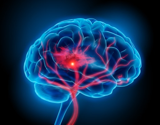 A Washington University in St. Louis team will study how the brain recovers from ischemic stroke with a $3.12 million grant from the National Institutes of Health. Credit: iStock photo