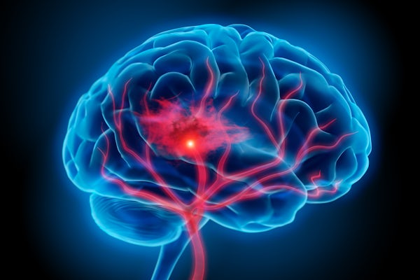 A Washington University in St. Louis team will study how the brain recovers from ischemic stroke with a $3.12 million grant from the National Institutes of Health. Credit: iStock photo