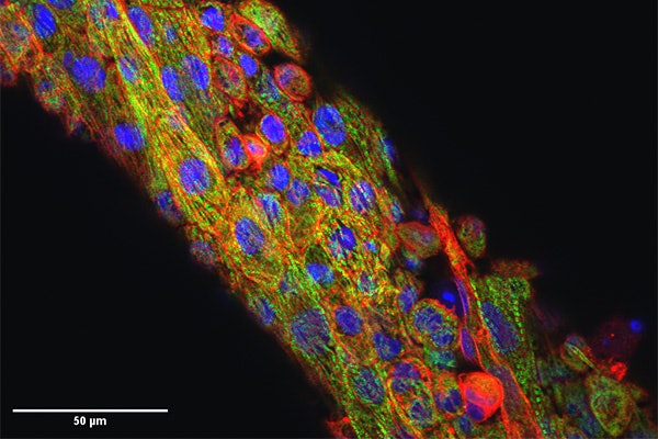 This image shows the microtissues from Nate Huebsch’s lab that are stained for cell nuclei (blue), sarcomeric alpha-actinic (red) and Myosin Binding Protein C (MYBPC3; green). Mutations in MYBPC3 cause hypertrophic cardiomyopathy.  These sarcomere structures are disrupted by chemical blebbistatin. (Huebsch lab)